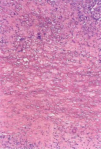 Necrobiotic xanthogranuloma. - Medscape