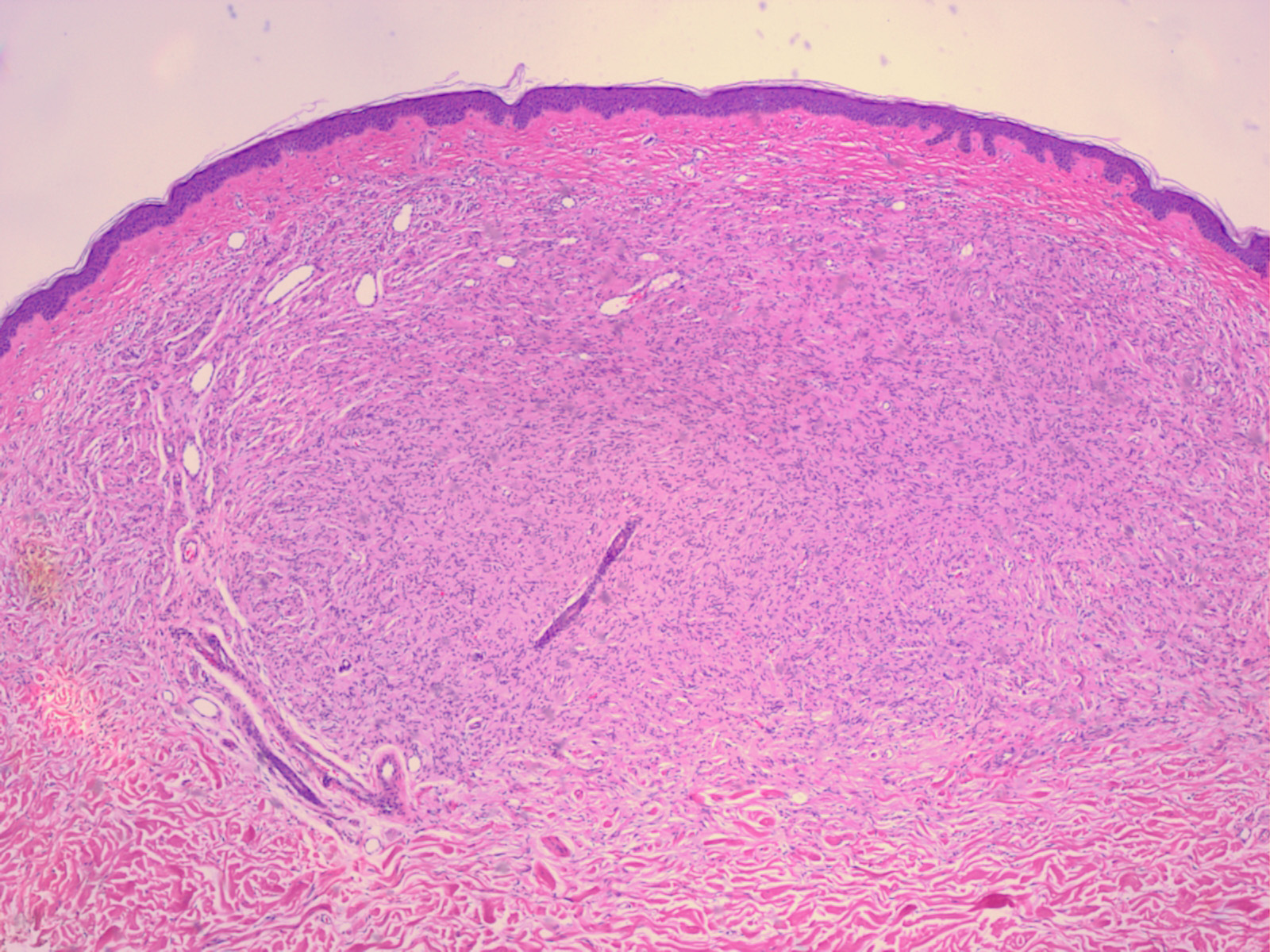 Neurofibroma - Wikipedia