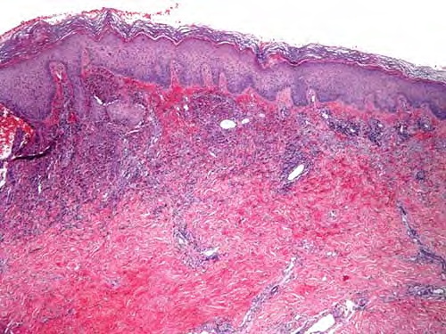 Febrile neutrophilic dermatosis - Wikipedia
