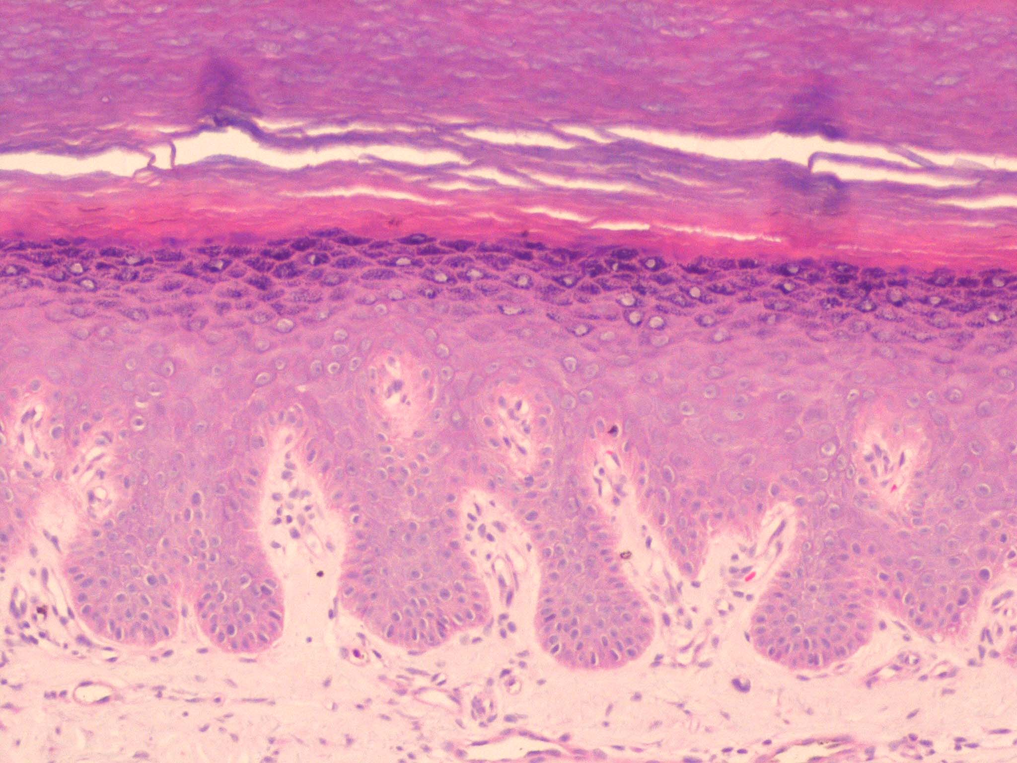 Palmoplantar keratoderma | DermNet New Zealand