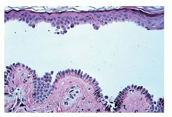 Acantholysis in Nederlands - Engels-Nederlands Woordenboek