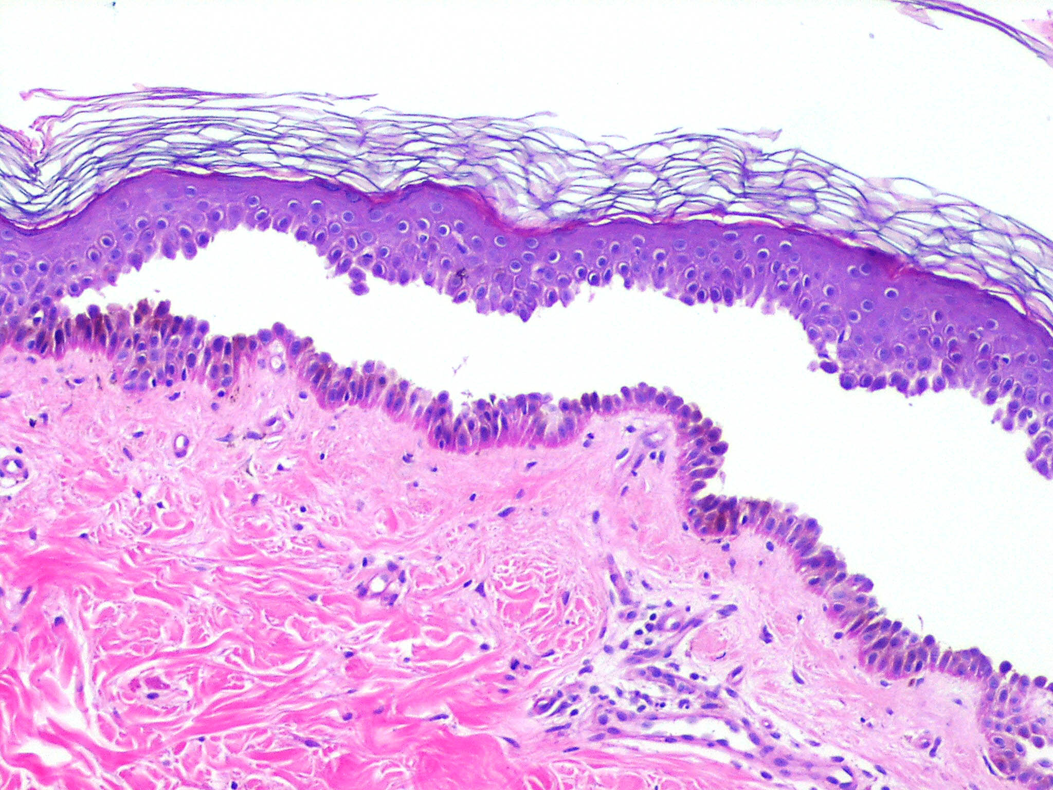 Pemphigus Skin Histology