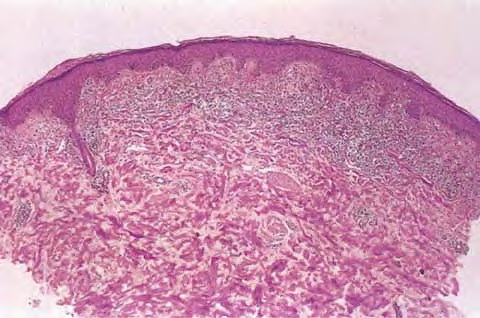 purpuric dermatosis #11