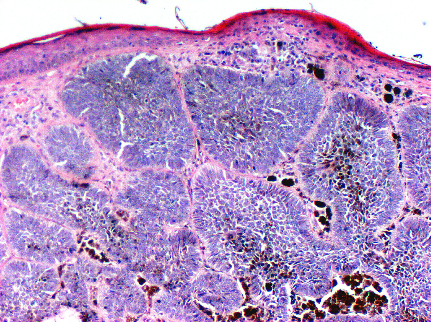 Pigmented Basal Cell Carcinoma الورم القاعدي الخلايا المصطبغ