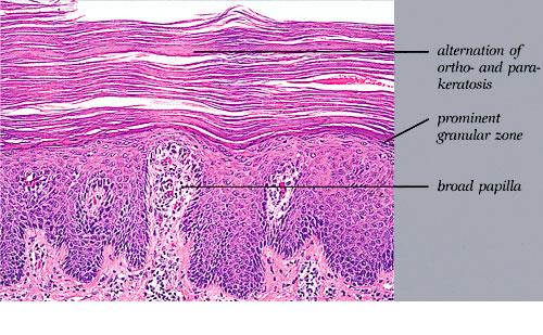 Fifth Disease Pictures and Treatment - eMedicineHealth