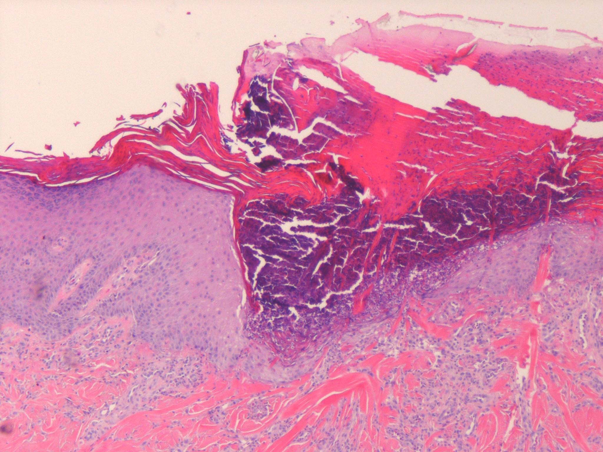 Reactive perforating collagenosis of diabetes mellitus ...