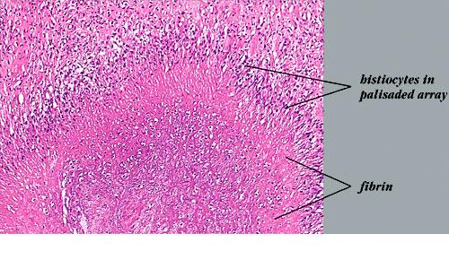 calcified thyroid nodule