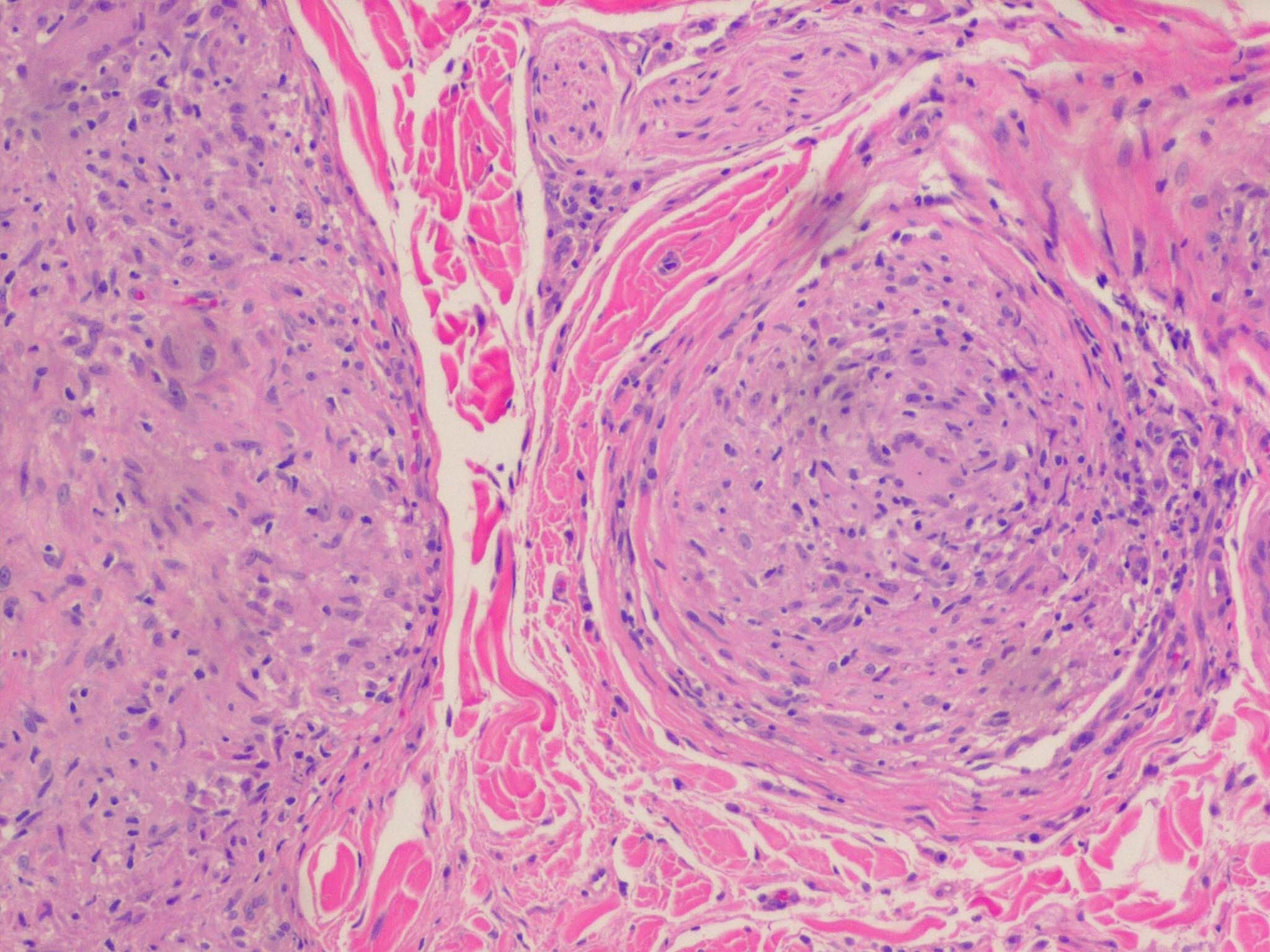 Sarcoid granulomatous interstitial nephritis and sarcoid ...