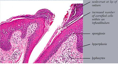 Spongiotic Dermatitis -Causes-Treatment - MedHelp