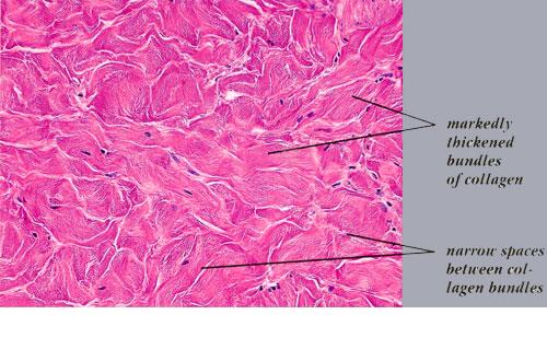 Panniculitis - Wikipedia