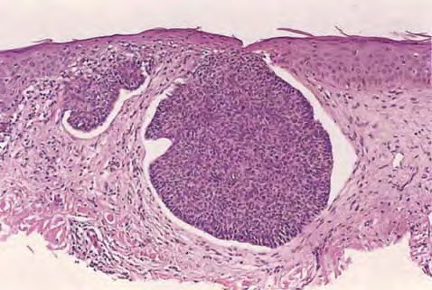 Skin Cancer - Merkel Cell Carcinoma: Background, History ...