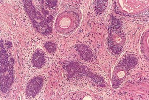 Trichoepithelioma: A Rare but Crucial Dermatologic Issue