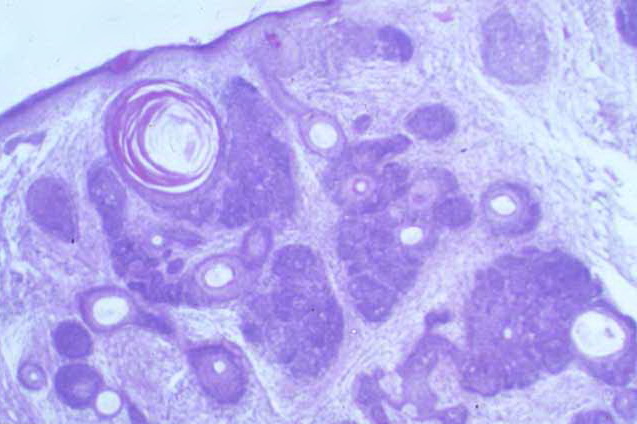 multiple familial trichoepithelioma - Genetics Home Reference