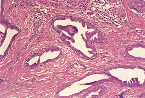 Tubular Apocrine Adenoma