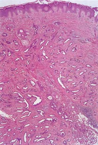 Tubular Apocrine Adenoma