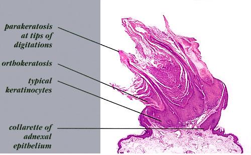 Verrucous Warts Overview - freeMD.com