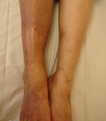 Acute Cutaneous Lupus Erythematosus