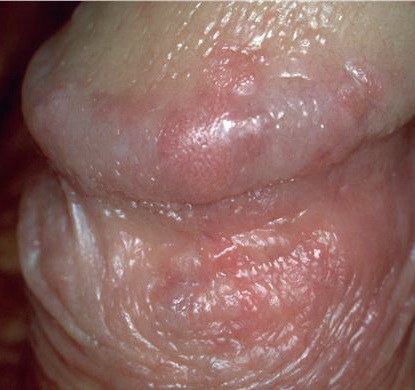 How to cure red spots on penile head