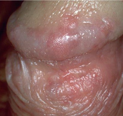 Bowenoid papulosis= الداء الحطاطي البوفناني