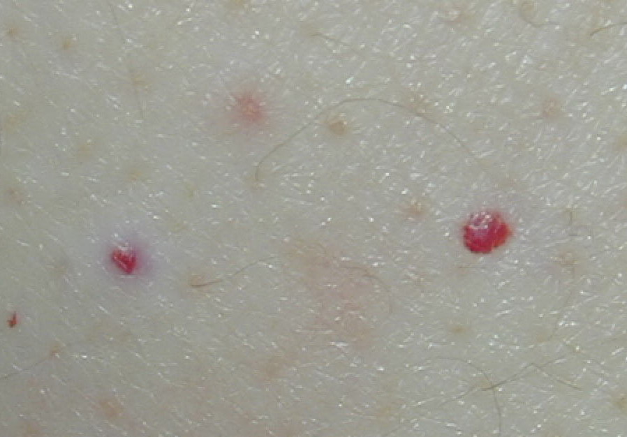 Cherry hemangiomas = ورم وعائي بشكل الكرز