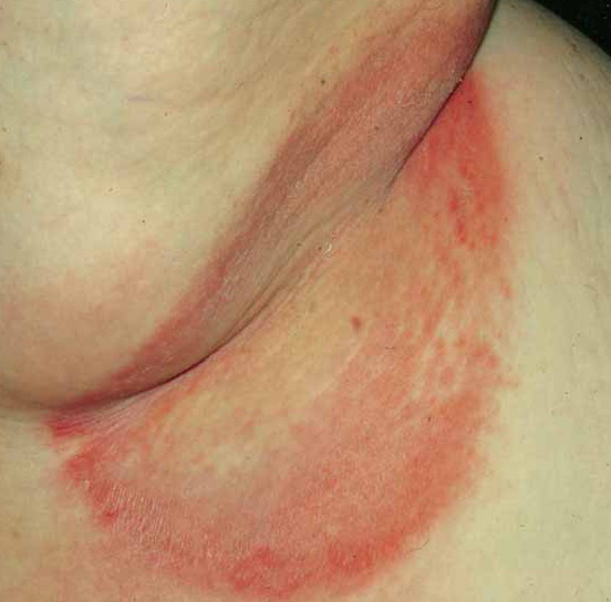 ...well-defined but irregular reddish brown patches, occurring in the inter...