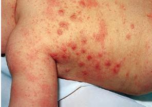 In malay scabies Scabies Guideline
