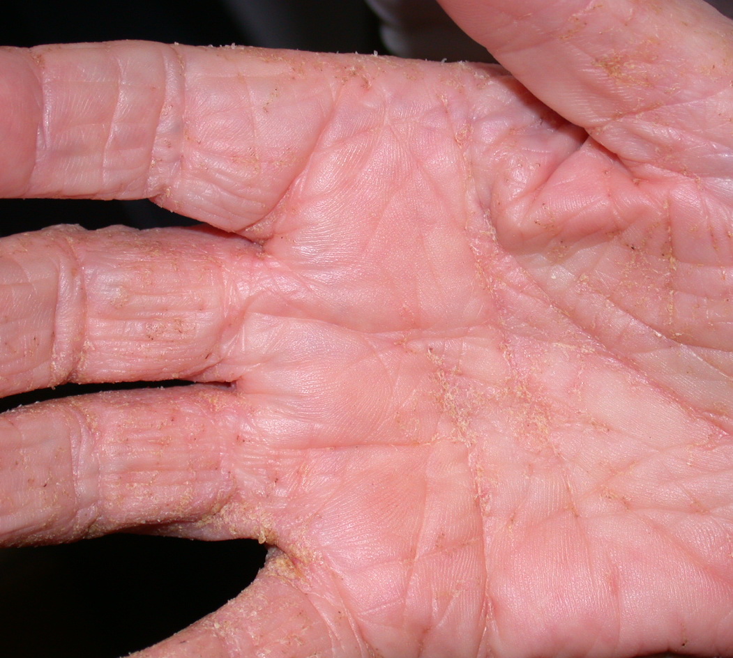 Norwegian scabies = الجرب النرويجي