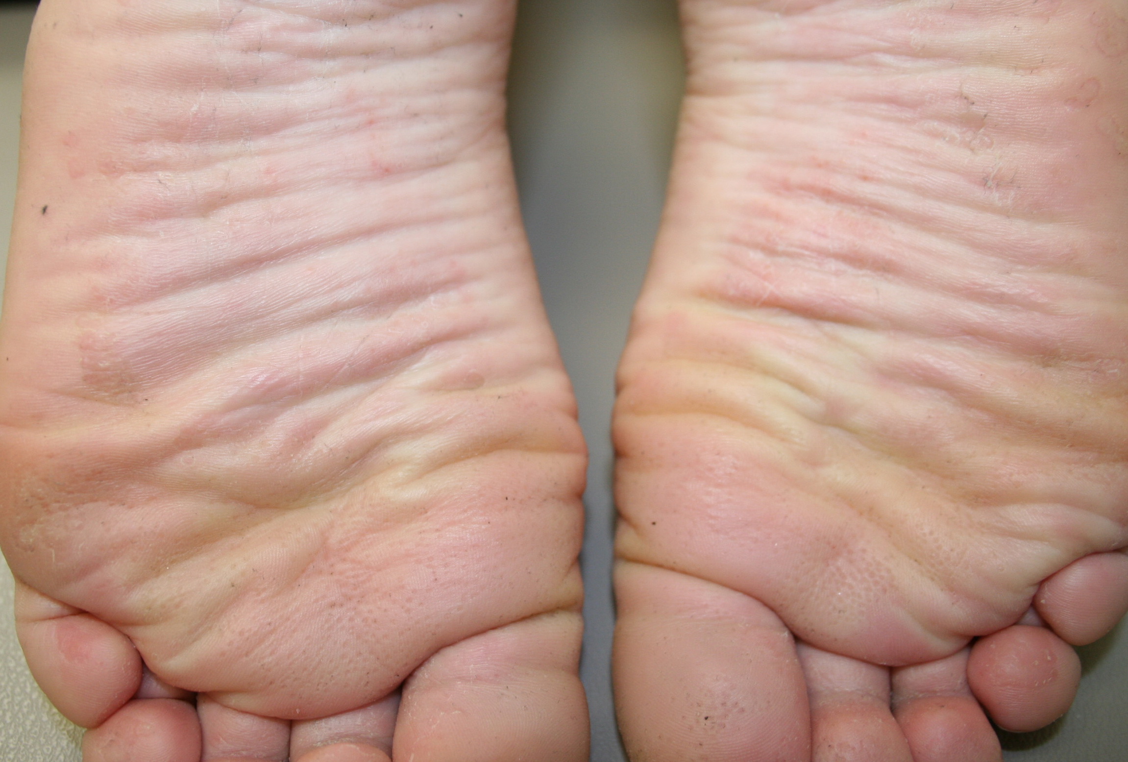 Pitted keratolysis = انحلال الطبقة القرنية المنقر