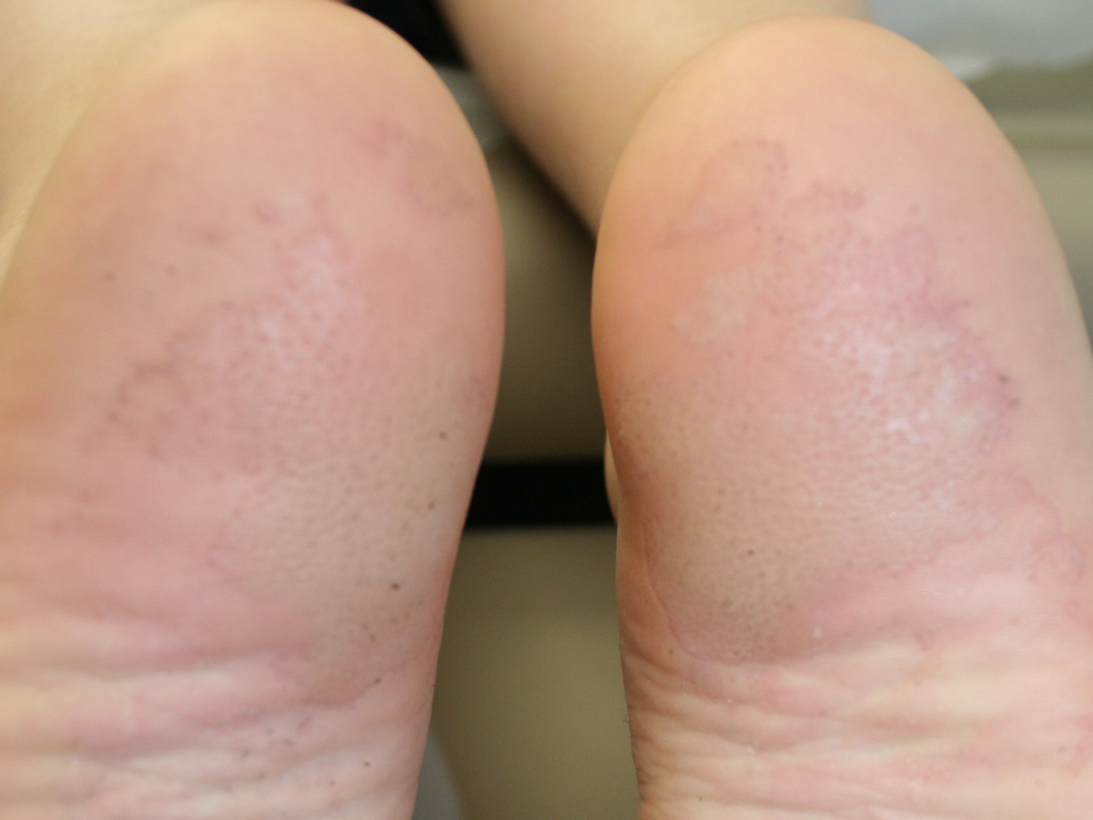 Pitted keratolysis = انحلال الطبقة القرنية المنقر