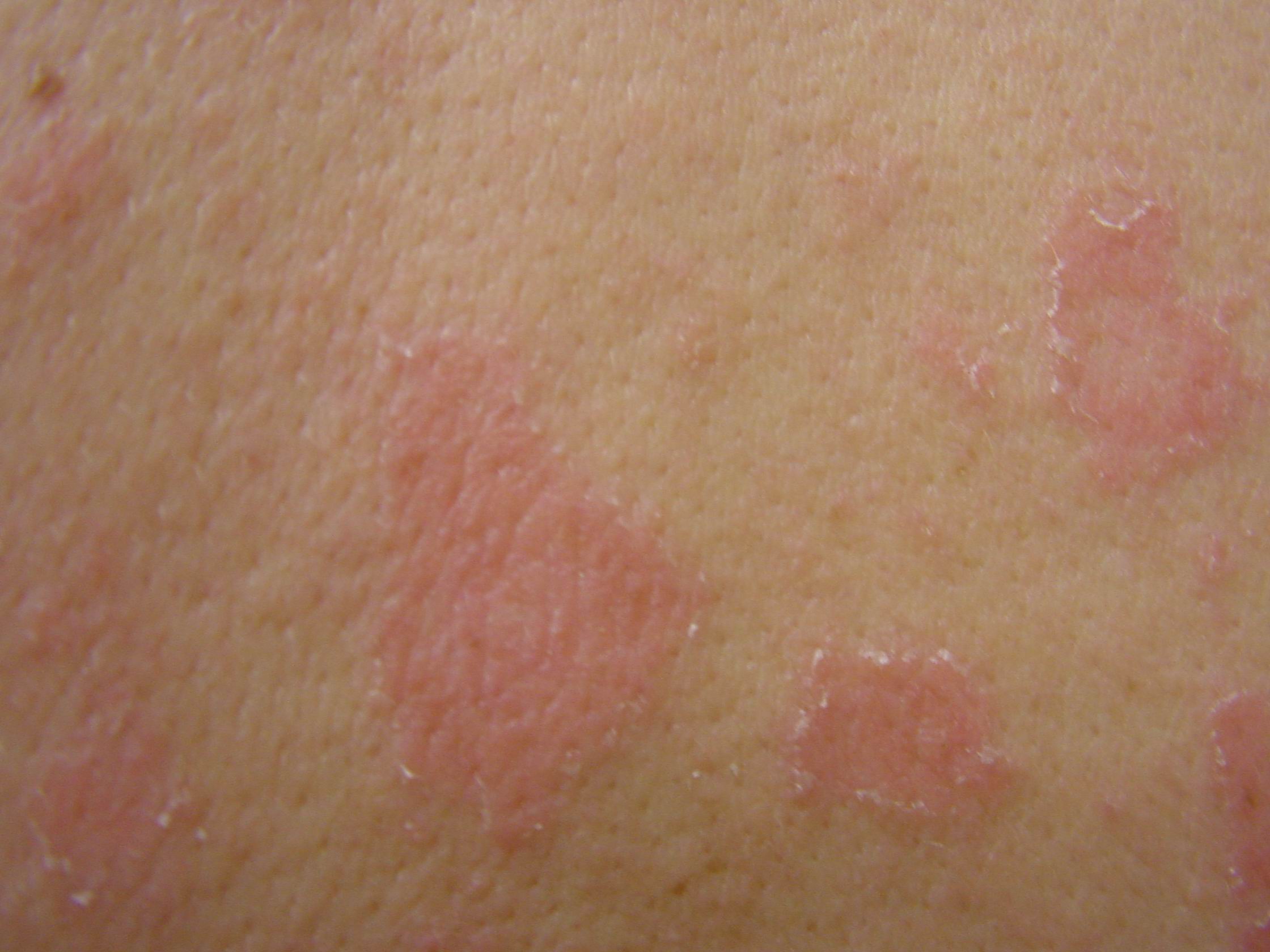 Pityriasis Rosea النخالية الوردية