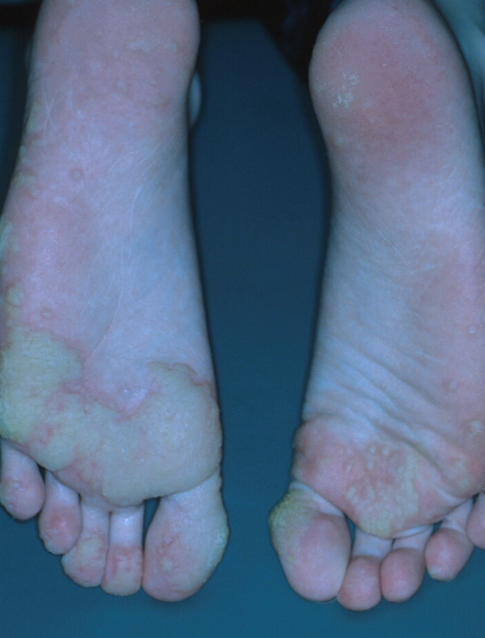 Plantar mosaic warts = الثأليل الاخمصية الفسيفسائية