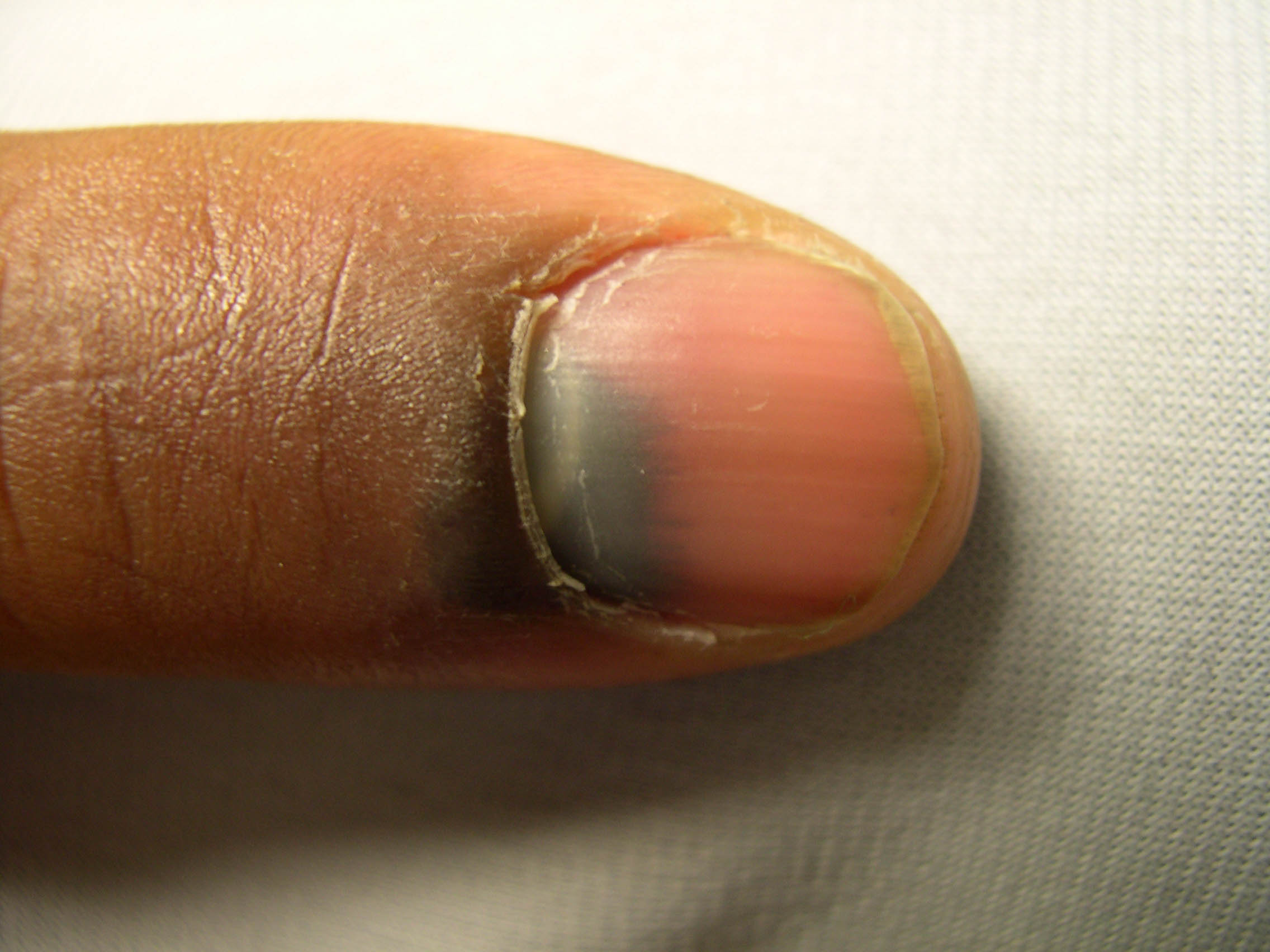 Subungual haematoma = الورم الدموي تحت الظفر