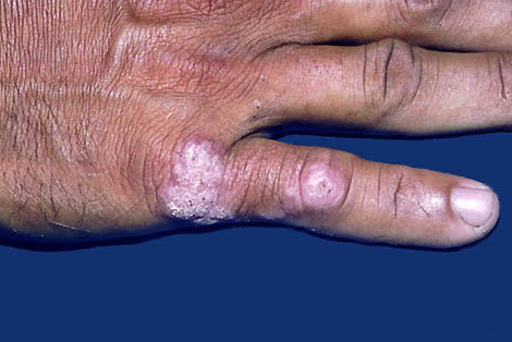 Tuberculosis verrucosa cutis = السل الجلدي الثؤلولي