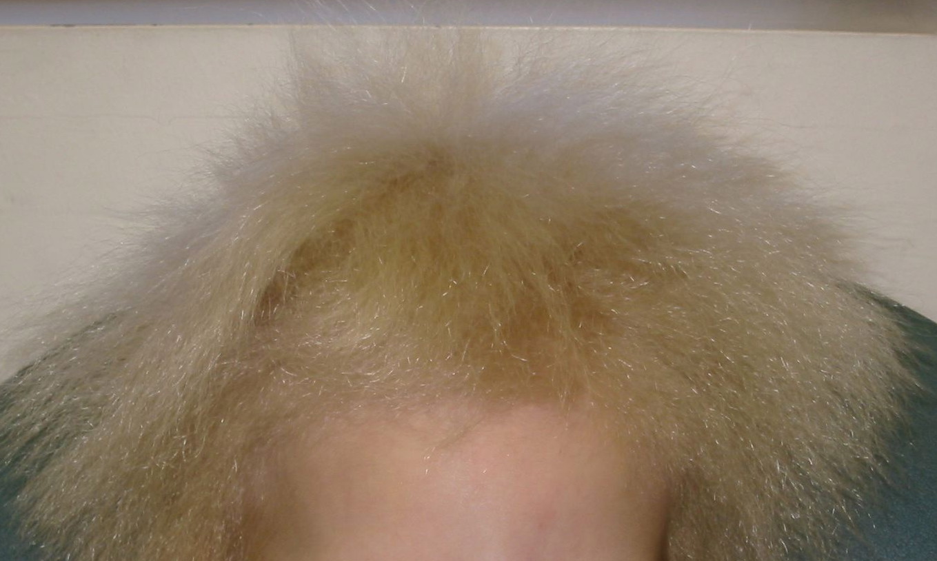 Болезнь курчавых волос