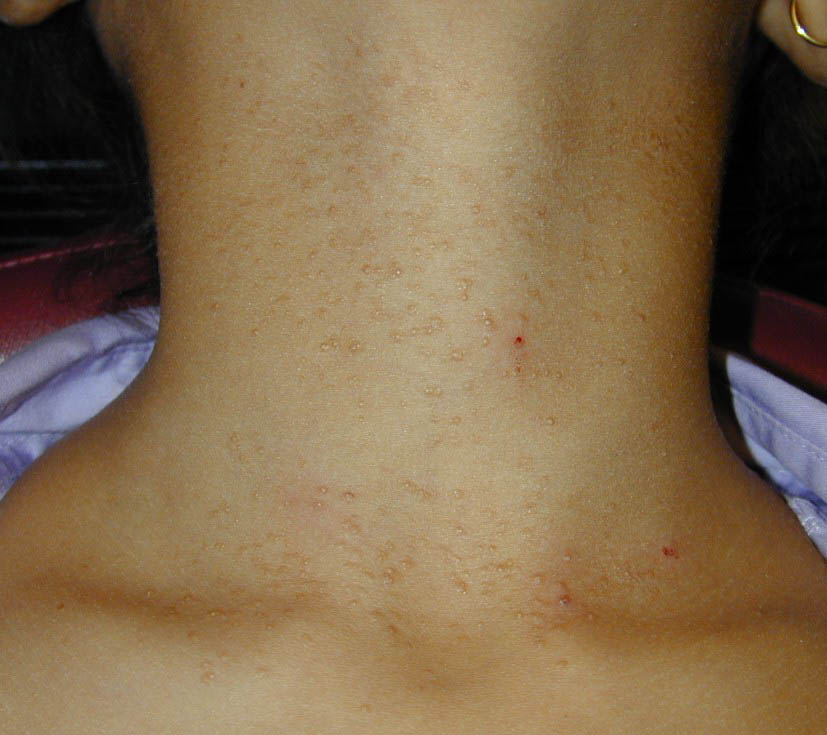 vellus hair cysts = كيسات الشعر الزغبي