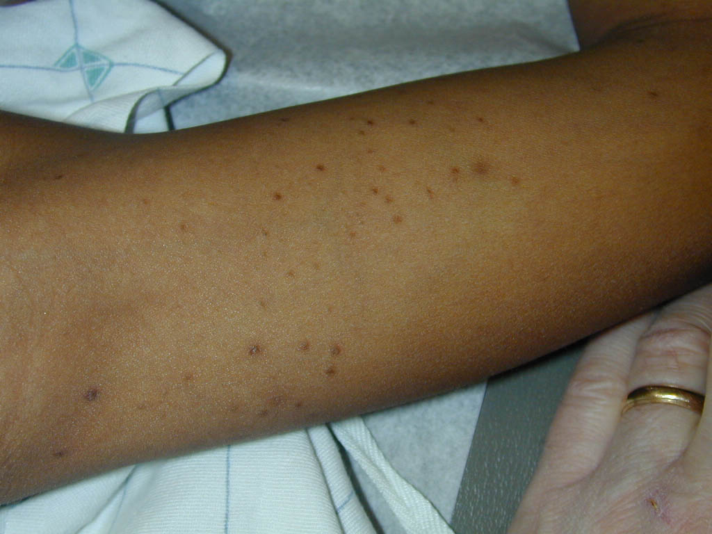 vellus hair cysts = كيسات الشعر الزغبي