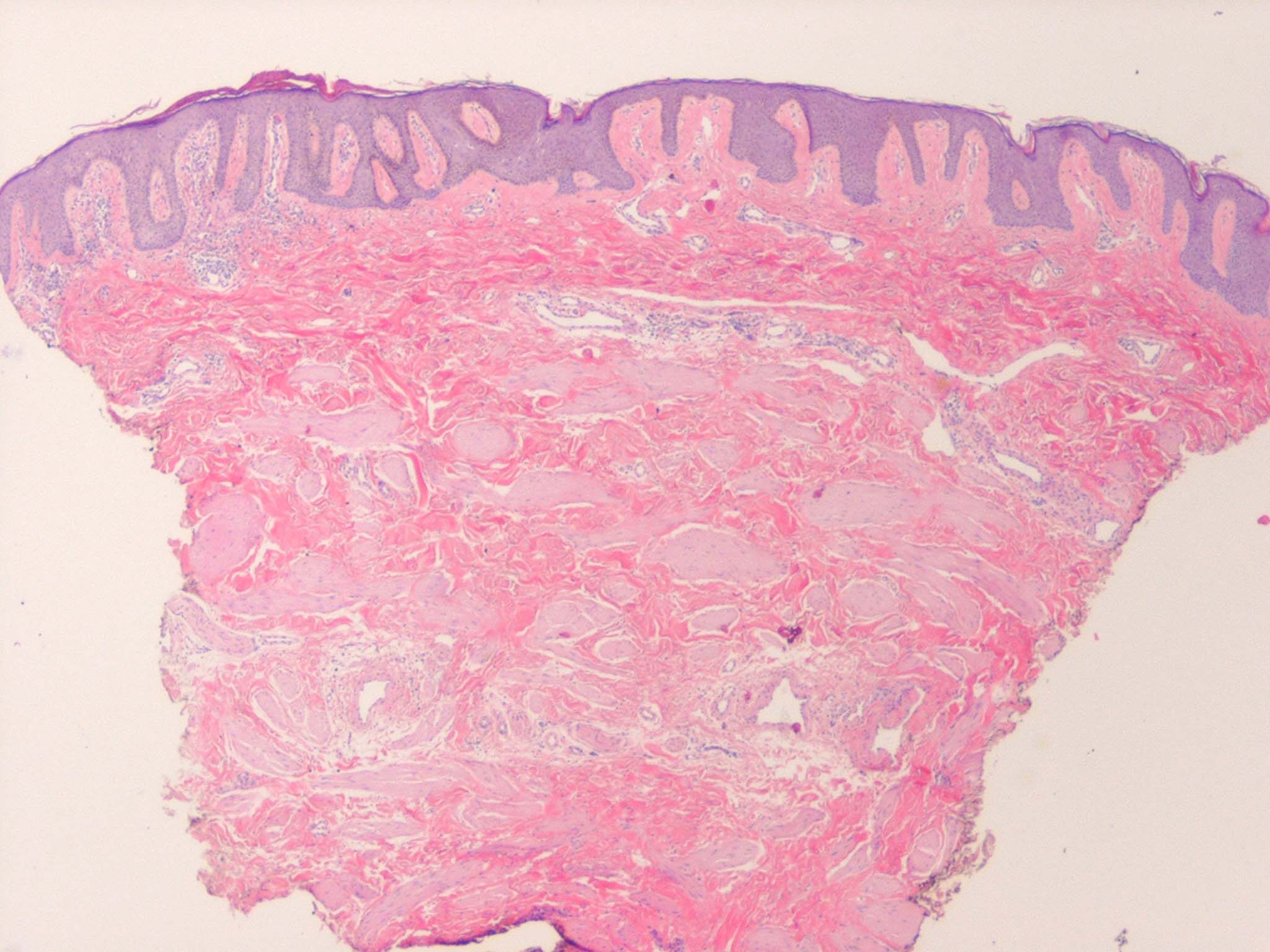 Accessory Nipple ='الحلمة الاضافية