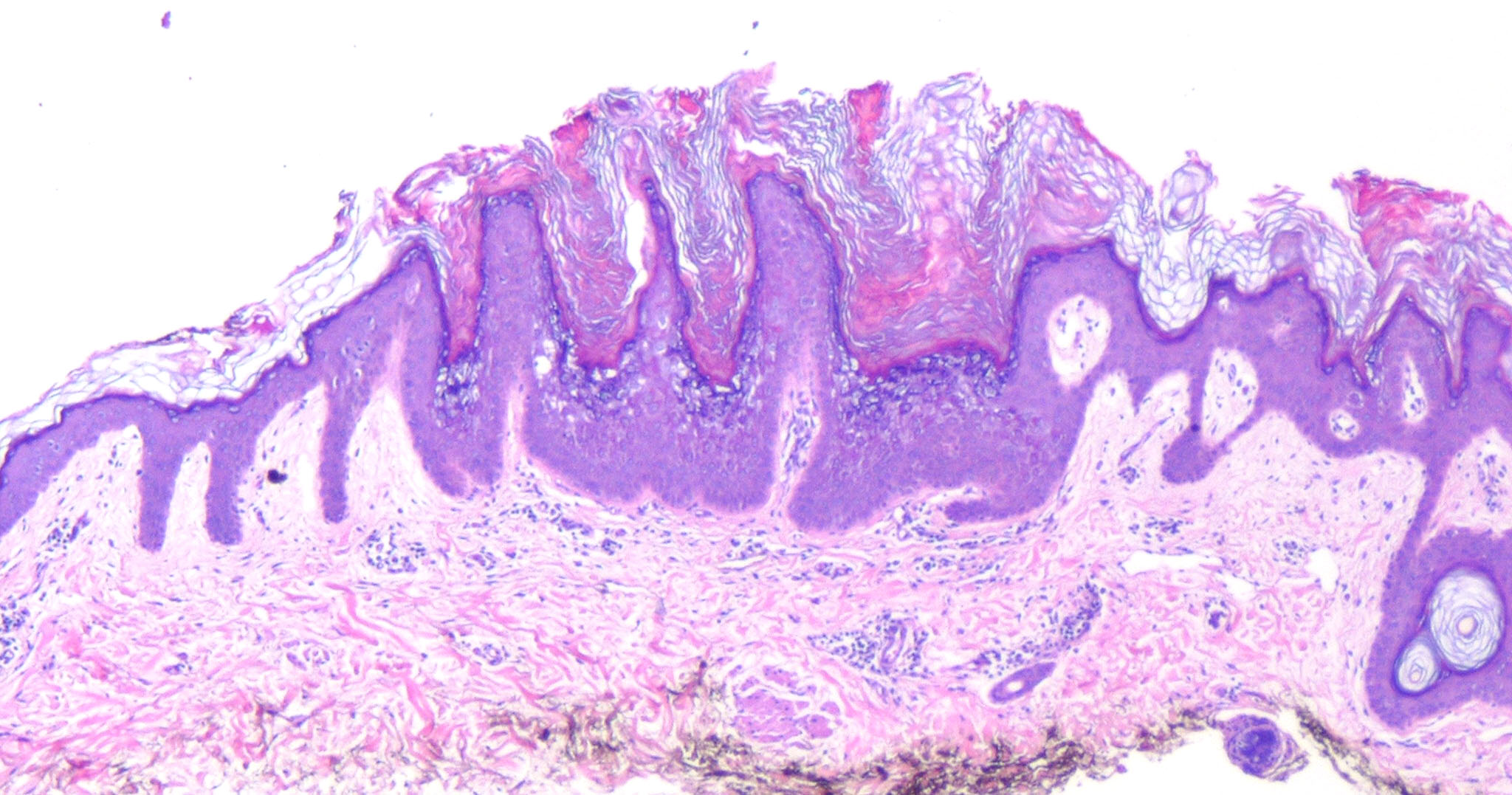 Epidermolytic Hyperkeratosis انحلال البشرة مفرط التقرن