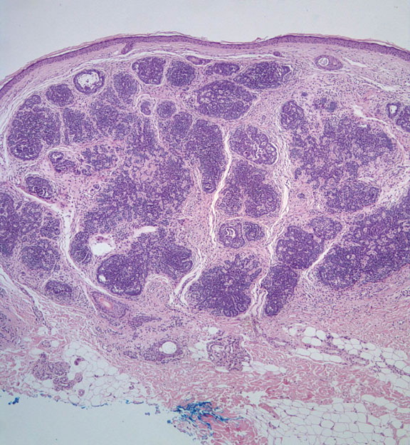 Trichoepithelioma =ورم ظهاري شعري
