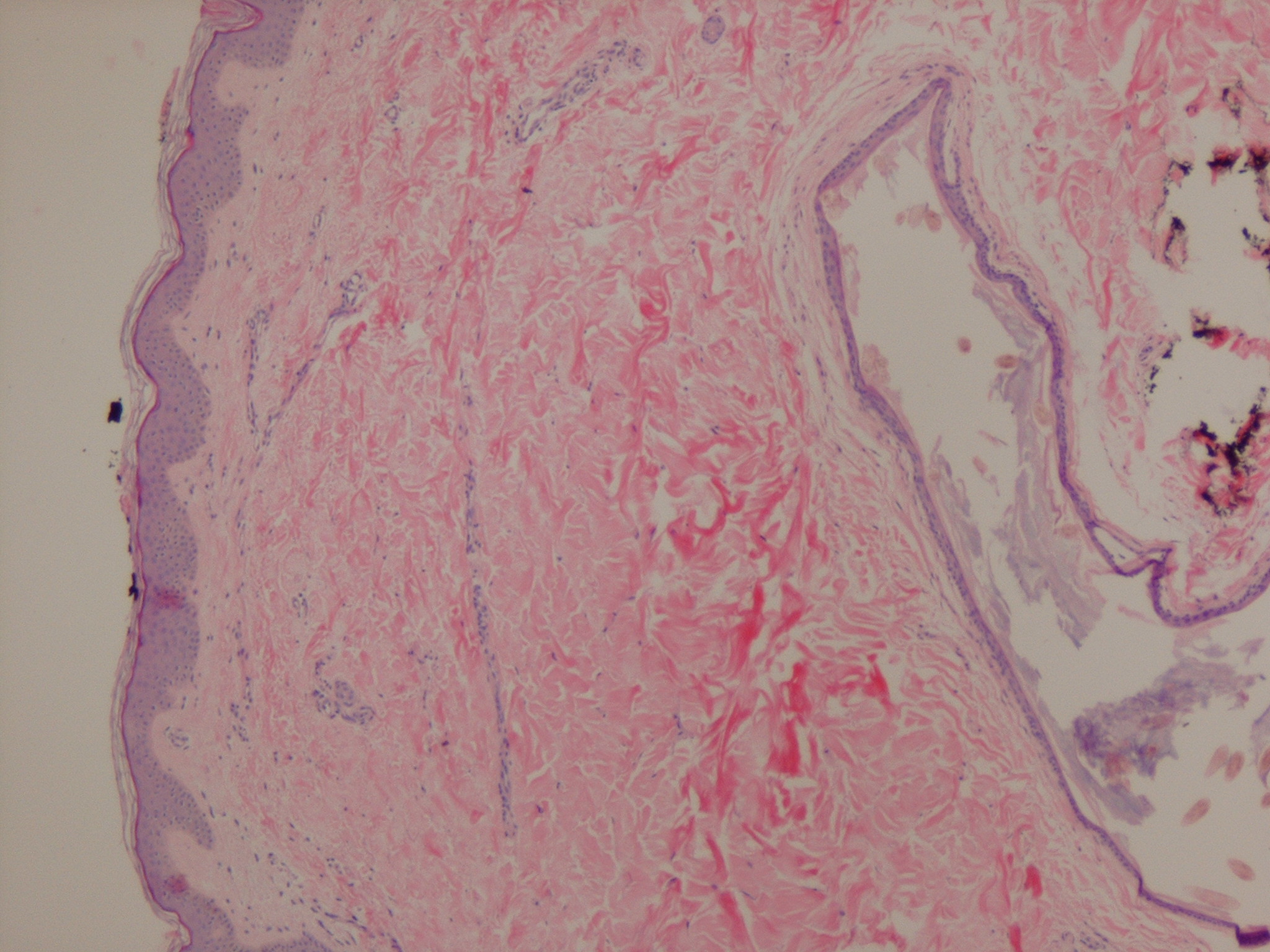 Vellus hair cysts = كيسات الشعر الزغبي